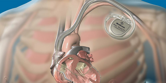 aicd-implantation