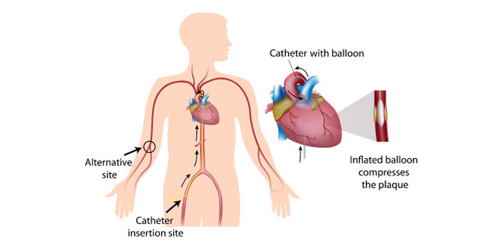 coronary-angiography