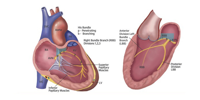 his-bundle-pacing