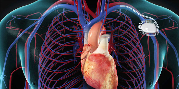 pacemaker-implantation